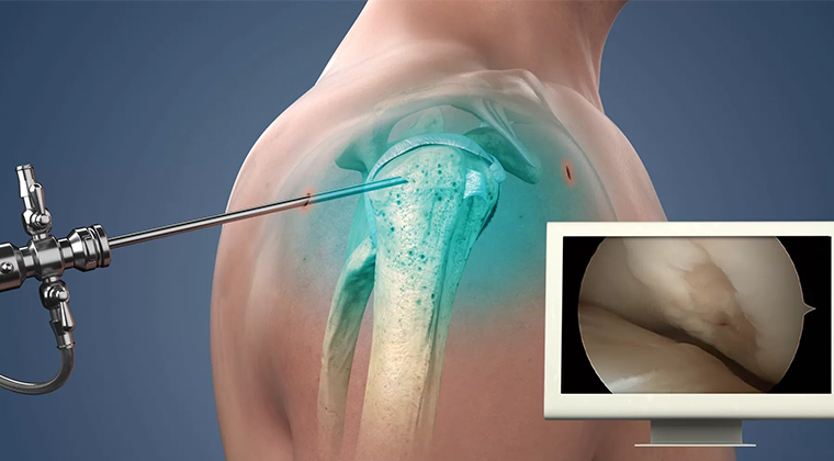 Artroscopia de Hombro